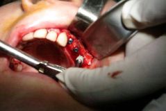 SIC implant live surgery _13